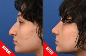 Before and after the nose job ( Image: Dr. Babak Azizzadeh)
