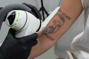 A client gets free laser removal of a Kanye West tattoos at Naama Studios. (Courtesy of Naama Studios)