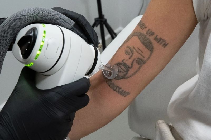 A client gets free laser removal of a Kanye West tattoos at Naama Studios. (Courtesy of Naama Studios)